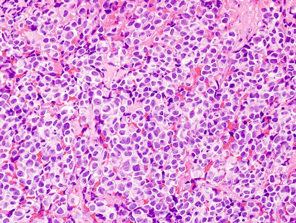 4B3 Pineoblastoma (Case 4) H&E 2.jpg