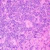 4B4 Pineoblastoma (Case 4) H&E 4.jpg