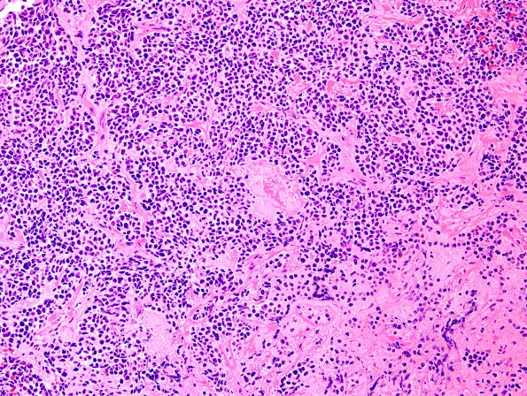 4B4 Pineoblastoma (Case 4) H&E 4.jpg