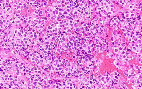 4B5 Pineoblastoma (Case 4) H&E 40X