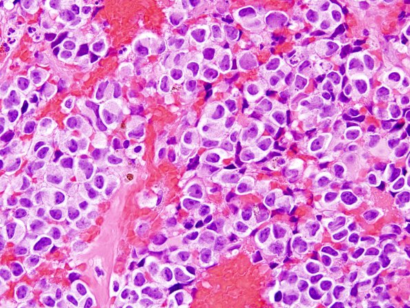 4B6 Pineoblastoma (Case 4) H&E 3.jpg