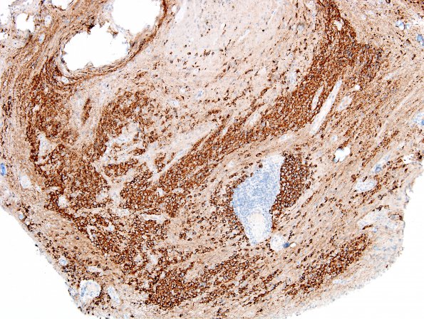 4C1 Pineoblastoma (Case 4) SYN 3.jpg