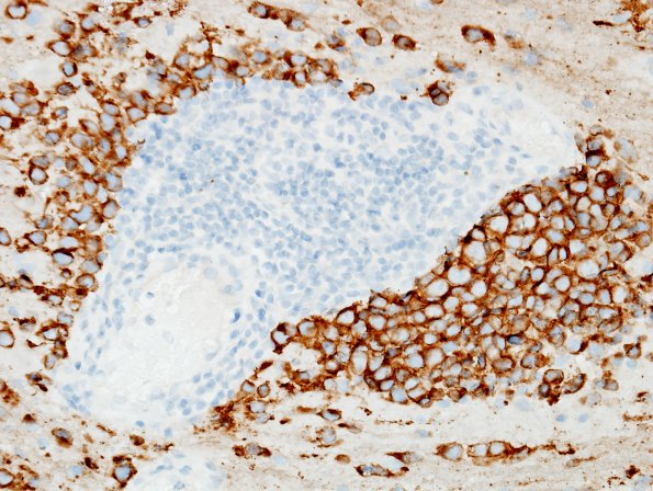 4C2 Pineoblastoma (Case 4) SYN 2.jpg