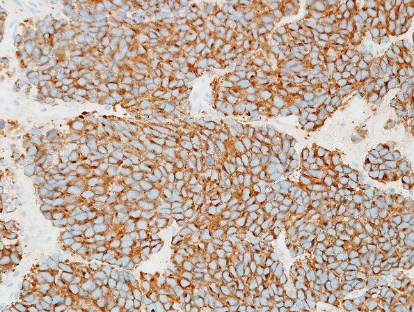 4C5 Pineoblastoma (Case 4) SYN 1