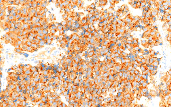 4C6 Pineoblastoma (Case 4) SYN 40X 2