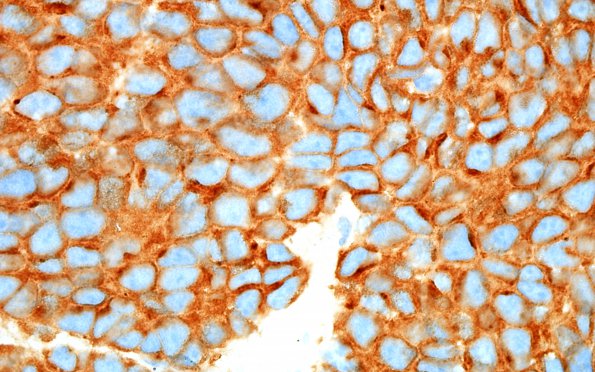 4C7 Pineoblastoma (Case 4) SYN 100X