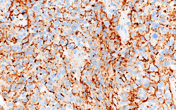 4D2 Pineoblastoma (Case 4) NF 40X