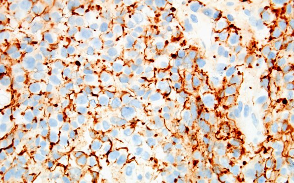 4D3 Pineoblastoma (Case 4) NF 60X