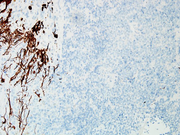 4E2 Pineoblastoma (Case 4) GFAP 3.jpg