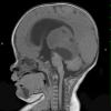 5A1 Pineoblastoma (Case 5) T1 1 - Copy