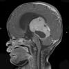 5A2 Pineoblastoma (Case 5) T1 W 3 - Copy