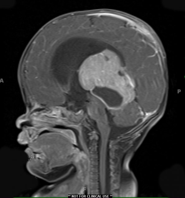 5A2 Pineoblastoma (Case 5) T1 W 3 - Copy