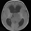 5A3 Pineoblastoma (Case 5) T1 2 - Copy