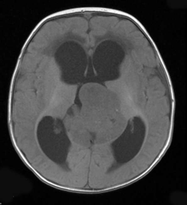 5A3 Pineoblastoma (Case 5) T1 2 - Copy