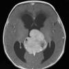 5A4 Pineoblastoma (Case 5) T1 W 1 - Copy