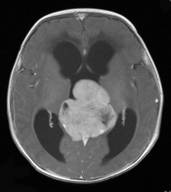 5A4 Pineoblastoma (Case 5) T1 W 1 - Copy