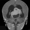 5A5 Pineoblastoma (Case 5) T1 W 2 - Copy