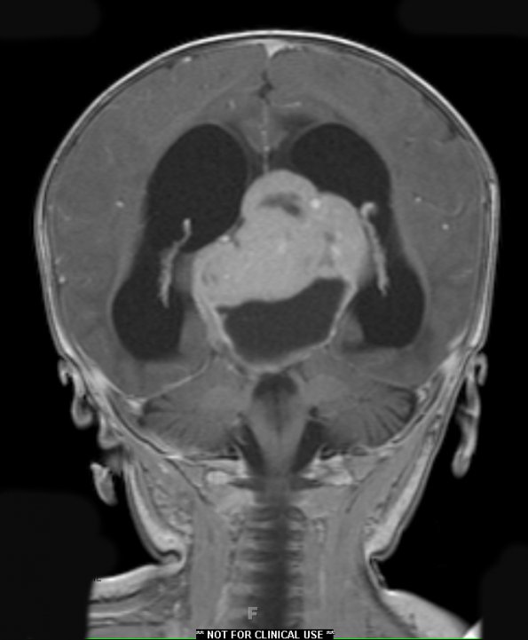 5A5 Pineoblastoma (Case 5) T1 W 2 - Copy