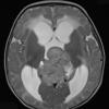 5A6 Pineoblastoma (Case 5) T2 1 - Copy