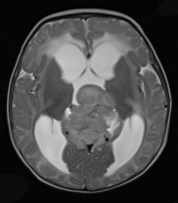 5A6 Pineoblastoma (Case 5) T2 1 - Copy