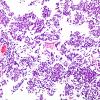 5B1 Pineoblastoma (Case 5) H&E 7.jpg