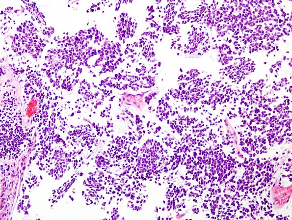 5B1 Pineoblastoma (Case 5) H&E 7.jpg