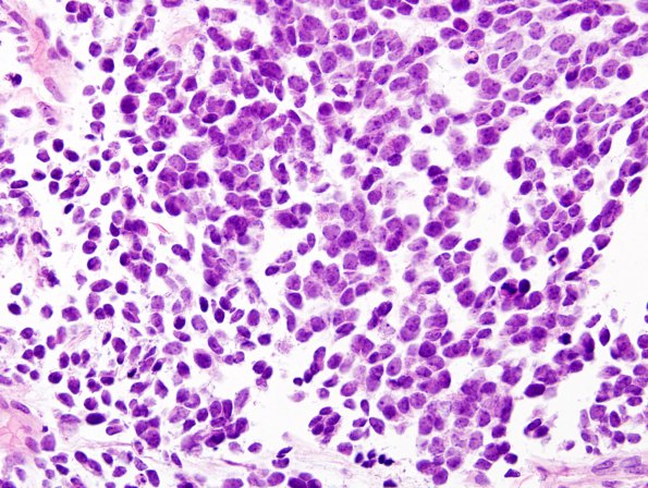 5B2 Pineoblastoma (Case 5) H&E 5.jpg