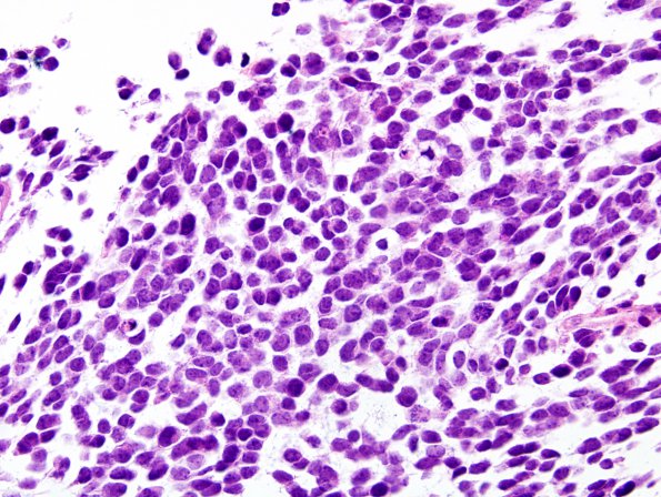 5B3 Pineoblastoma (Case 5) H&E 2.jpg