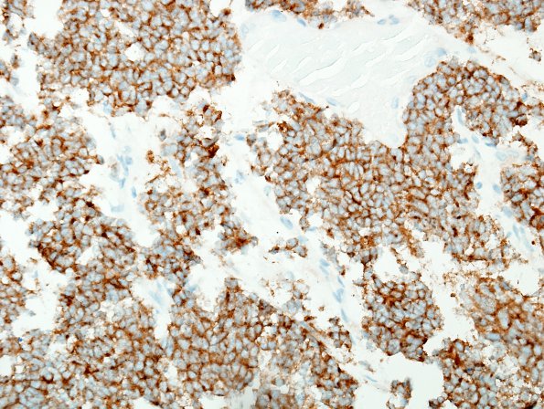 5C1 Pineoblastoma (Case 5) SYN 3.jpg