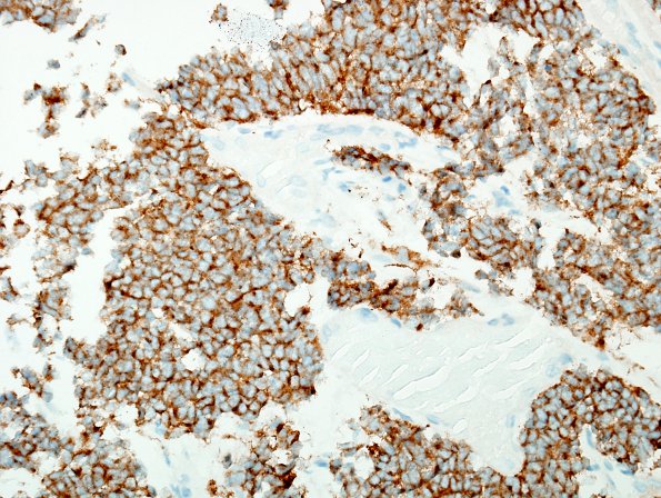 5C2 Pineoblastoma (Case 5) SYN 2.jpg