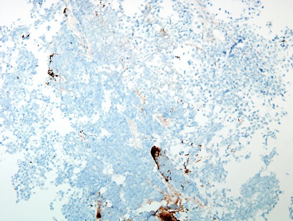 5D Pineoblastoma (Case 5) GFAP set on 0.jpg