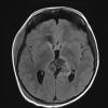 6A1 Pineoblastoma (Case 6) FLAIR - Copy