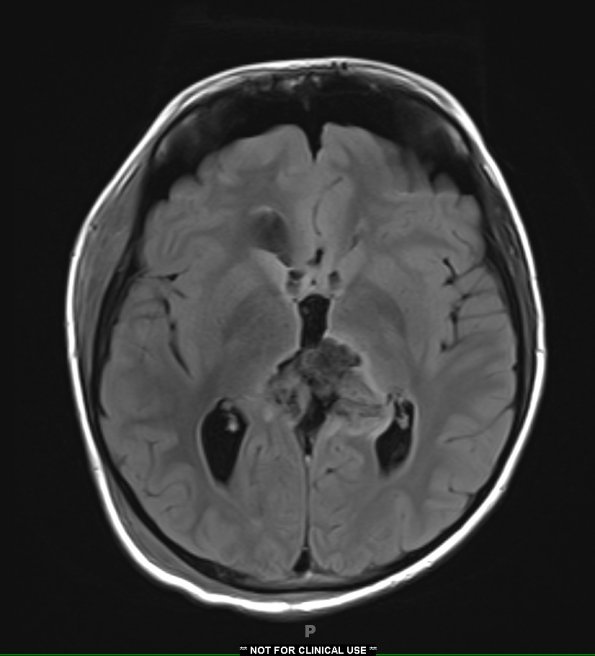 6A1 Pineoblastoma (Case 6) FLAIR - Copy