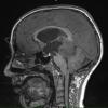 6A2 Pineoblastoma (Case 6) T1 no contrast - Copy