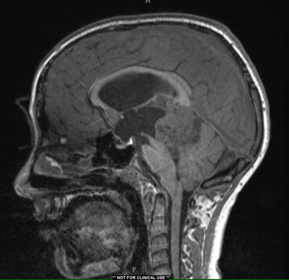 6A2 Pineoblastoma (Case 6) T1 no contrast - Copy