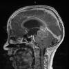 6A3 Pineoblastoma (Case 6) T1 with contrast 3 - Copy