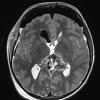 6A4 Pineoblastoma (Case 6) T2 no contrast - Copy