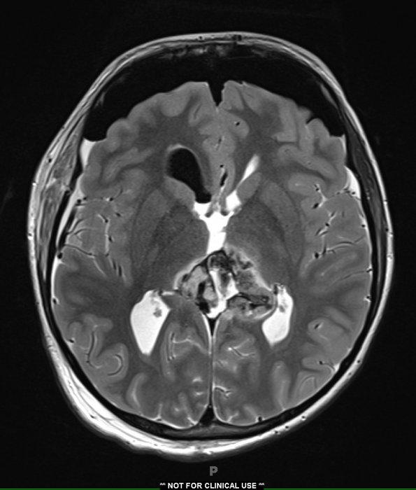 6A4 Pineoblastoma (Case 6) T2 no contrast - Copy