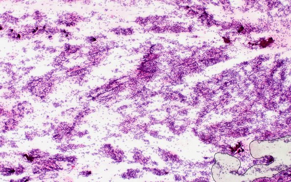 6B1 Pineoblastoma (Case 6) H&E smear