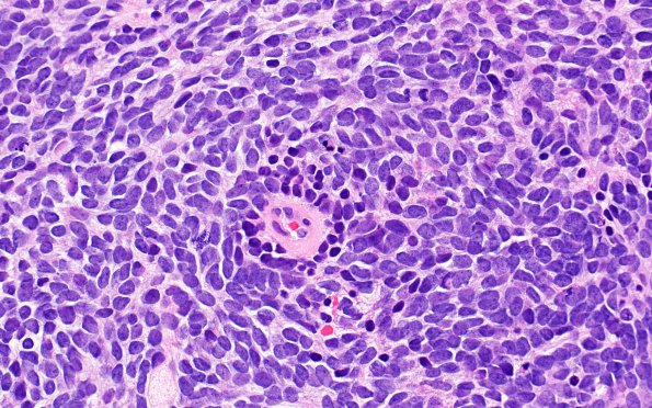 6B2 Pineoblastoma (Case 6) H&E 3