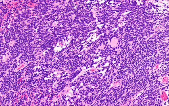 6B3 Pineoblastoma (Case 6) H&E 8