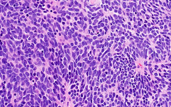 6B4 Pineoblastoma (Case 6) H&E 4