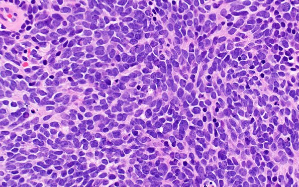 6B5 Pineoblastoma (Case 6) H&E 5