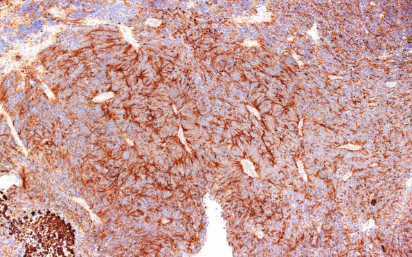 6D1 Pineoblastoma (Case 6) NF 5