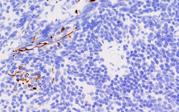 6E Pineoblastoma (Case 6) GFAP 2