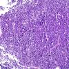 7A1 Pineoblastoma (Case 7) H&E 10X