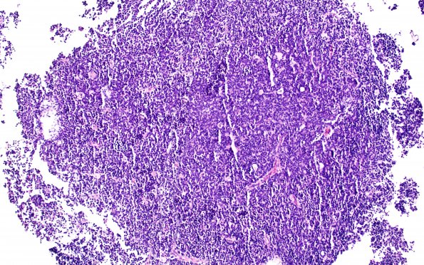 7A1 Pineoblastoma (Case 7) H&E 10X