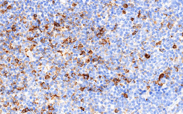 7C1 Pineoblastoma (Case 7) NF 40X