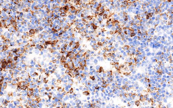 7C2 Pineoblastoma (Case 7) NF 60X