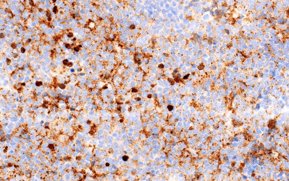 7D Pineoblastoma (Case 7) Chromogranin 40X